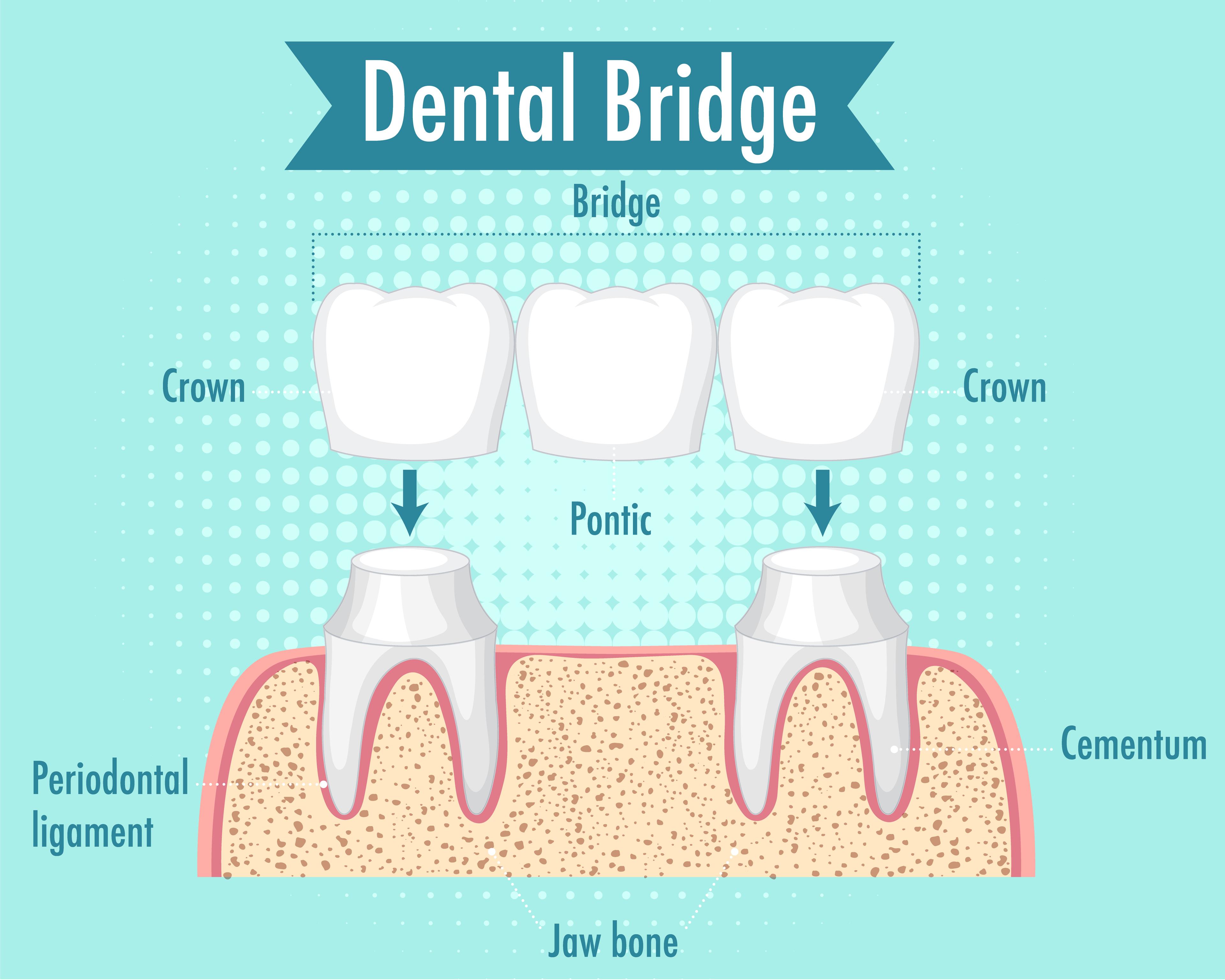 Crowns and Bridges