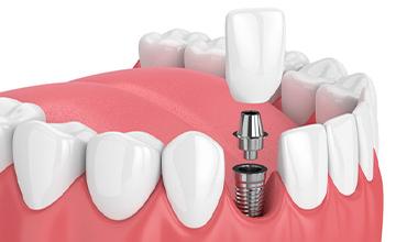 Dental Implants