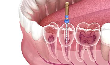 Endodontics