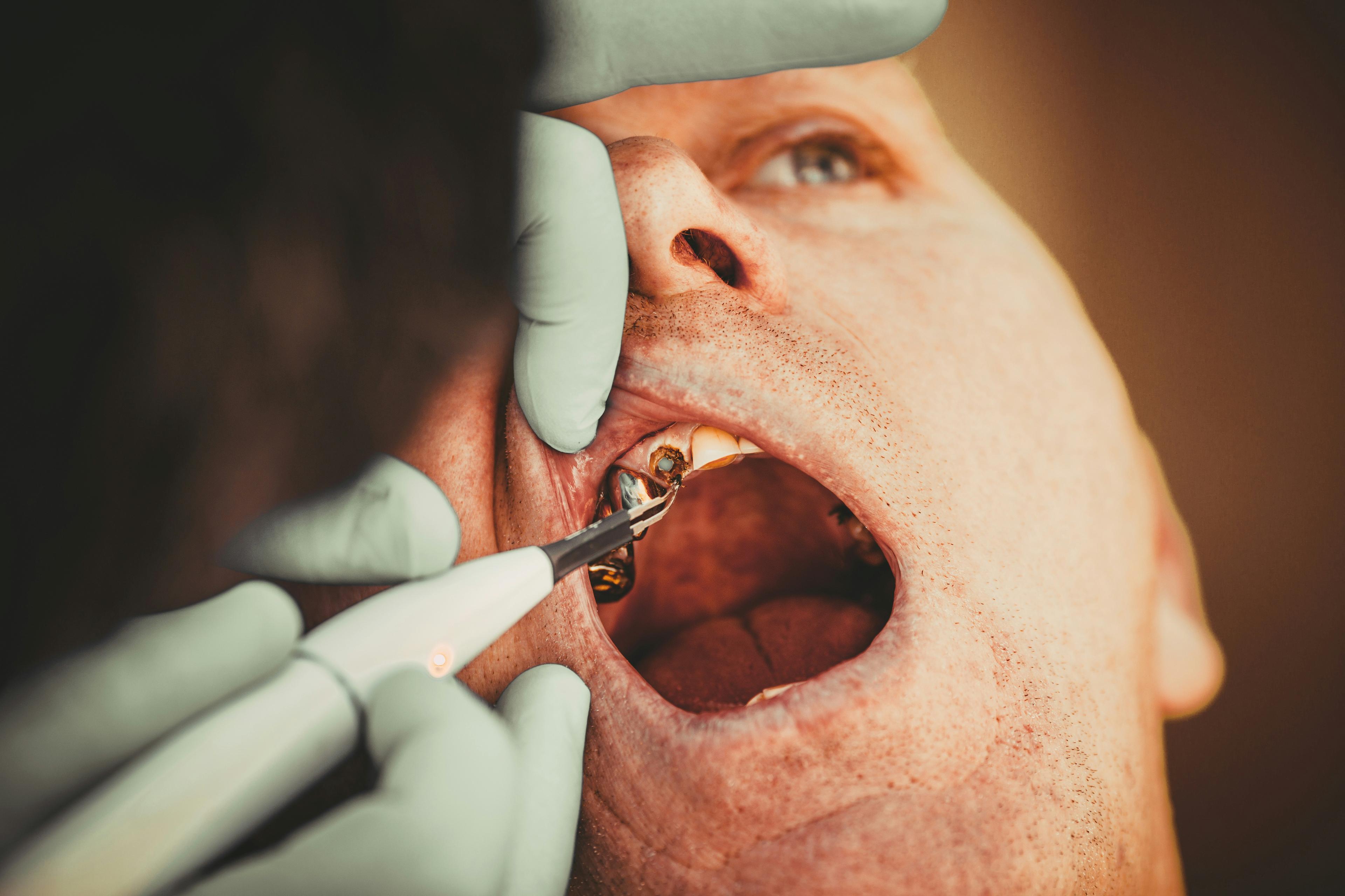 tooth extraction